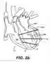 Fig. 04 - Methods and devices for improving mitral valve function