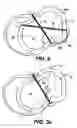 Fig. 06 - Methods and devices for improving mitral valve function