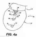 Fig. 07 - Methods and devices for improving mitral valve function