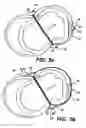 Fig. 09 - Methods and devices for improving mitral valve function