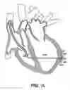 Fig. 28 - Methods and devices for improving mitral valve function