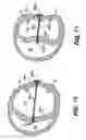 Fig. 34 - Methods and devices for improving mitral valve function