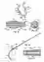 Fig. 08 - Electrophysiology loop catheter