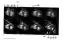 Fig. 01 - Non-invasive left ventricular volume determination