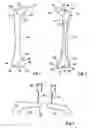 Fig. 02 - Method and system of computer assistance for the reduction of a fracture