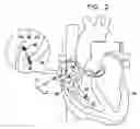 Fig. 03 - Reference catheter for impedance calibration
