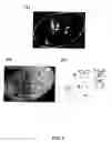 Fig. 06 - Quantitative non-invasive method for detecting degree of malignancy in tumors and application thereof