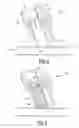 Fig. 06 - Extracorporeal emboli detector