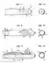 Fig. 02 - Biopsy method
