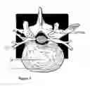 Fig. 03 - Nucleus Extraction from Spine Intervertebral Disc