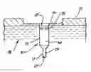 Fig. 01 - Arthroscopic chondrocyte implantation method and device