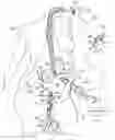 Fig. 01 - Intra-abdominal medical method
