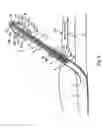 Fig. 07 - Tissue closure and tissue closing device