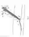 Fig. 10 - Tissue closure and tissue closing device