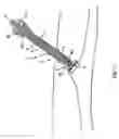 Fig. 12 - Tissue closure and tissue closing device