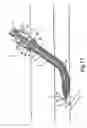 Fig. 18 - Tissue closure and tissue closing device