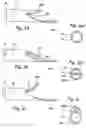 Fig. 03 - Device and methods useable for treatment of glaucoma and other surgical procedures