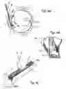 Fig. 06 - Device and methods useable for treatment of glaucoma and other surgical procedures