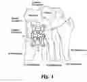 Fig. 02 - Mid-foot fixation plate