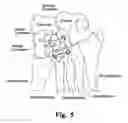 Fig. 04 - Mid-foot fixation plate