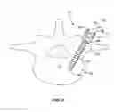 Fig. 04 - Multi-piece vertebral attachment device