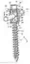 Fig. 01 - Force limiting coupling assemblies for spinal implants