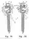 Fig. 03 - Force limiting coupling assemblies for spinal implants