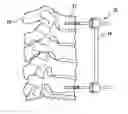 Fig. 01 - Open dorsal adjusting connector