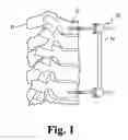 Fig. 02 - Open dorsal adjusting connector