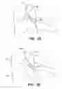 Fig. 03 - Inter-cervical facet joint implant with locking screw system