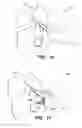 Fig. 07 - Inter-cervical facet joint implant with locking screw system