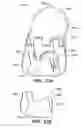 Fig. 15 - Inter-cervical facet joint implant with locking screw system