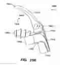 Fig. 18 - Inter-cervical facet joint implant with locking screw system