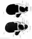 Fig. 19 - Inter-cervical facet joint implant with locking screw system