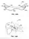Fig. 22 - Inter-cervical facet joint implant with locking screw system