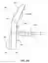 Fig. 40 - Inter-cervical facet joint implant with locking screw system