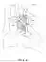 Fig. 46 - Inter-cervical facet joint implant with locking screw system