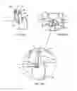 Fig. 13 - Interspinous vertebral and lumbosacral stabilization devices and methods of use