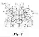 Fig. 02 - Implants and methods for inter-transverse process dynamic stabilization of a spinal motion segment