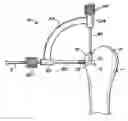 Fig. 01 - Method and apparatus for surgical repair
