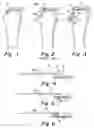 Fig. 02 - Method and apparatus for surgical repair