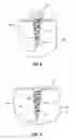 Fig. 04 - Slotted screw for use with a vertebral member