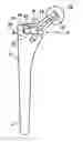Fig. 01 - Hip stem instrument with releasable connection
