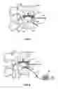 Fig. 06 - Revision methods for a vertebral device