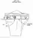 Fig. 01 - Method and apparatus for forming a wedge-like opening in a bone for an open wedge osteotomy