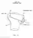 Fig. 22 - Method and apparatus for forming a wedge-like opening in a bone for an open wedge osteotomy