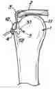 Fig. 01 - Method and apparatus for providing suture in a passageway