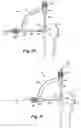 Fig. 04 - Method and apparatus for providing suture in a passageway