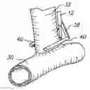Fig. 01 - Anastomosis system with flexible shaft