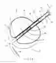 Fig. 10 - Subcision device